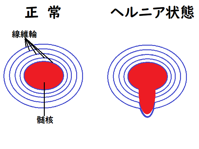 髄核